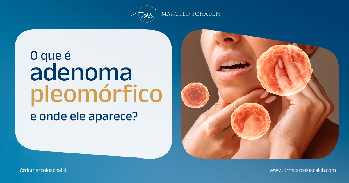 O que é adenoma pleomórfico e onde ele aparece? - Dr. Marcelo Schalch ...